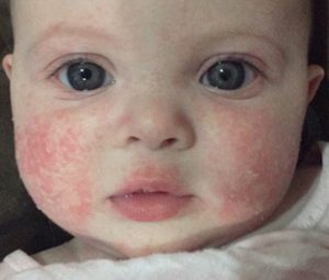 Eczema in Baby