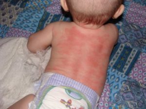 Hives in Baby