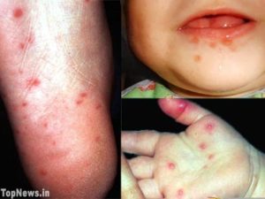 Mouth Hand and Foot Disease