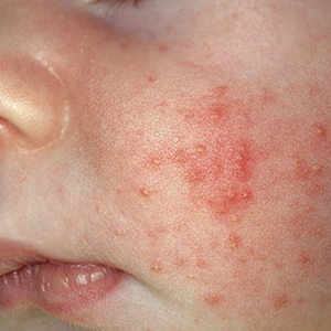 How To Treat Baby Rash The Most Common Rashes Their Treatments