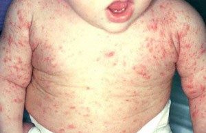 Homemade Treatment for Baby Scabies Rash